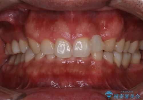 前歯のステインを取りたい PMTCできれいにの治療後