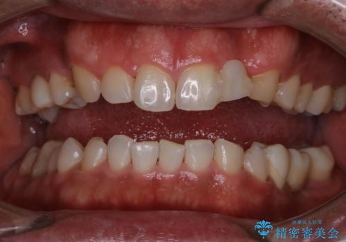 前歯のステインを取りたい　PMTCできれいにの症例 治療後