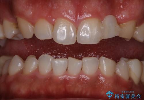 前歯のステインを取りたい PMTCできれいにの治療後