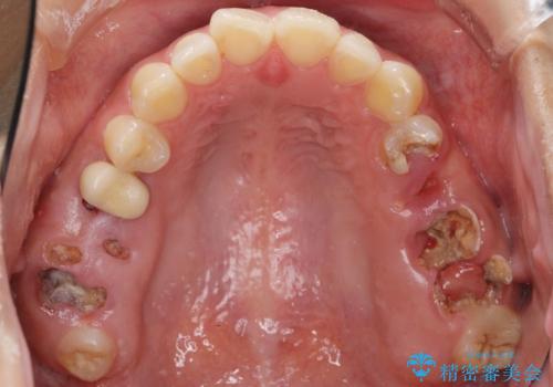 インプラントも入れ歯も嫌 親知らずの移植 20代女性の治療前