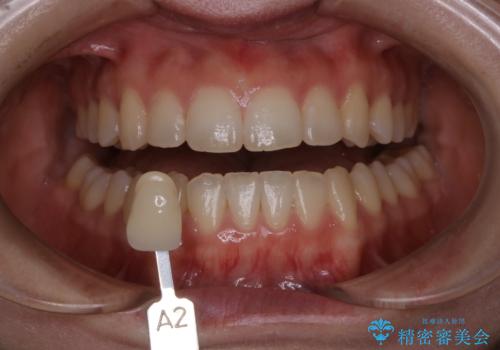 初めてのホワイトニングで自然な白さにしたいの治療前