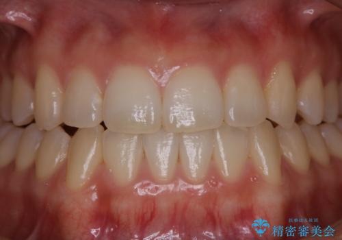 初めてのホワイトニングで自然な白さにしたいの治療前