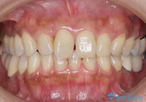 歯が痛い 深いう蝕により神経が死んでいる 50代女性の治療前