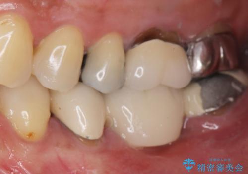 歯が痛い 深いう蝕により神経が死んでいる 50代女性の治療前