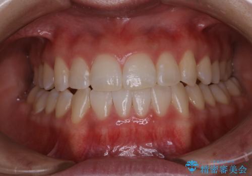 初めてのホワイトニングで自然な白さにしたいの症例 治療後