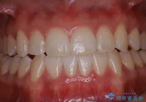 初めてのホワイトニングで自然な白さにしたいの治療後