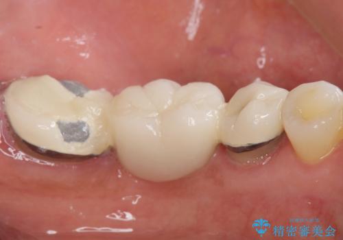 歯が痛い 深いう蝕により神経が死んでいる 50代女性の治療前