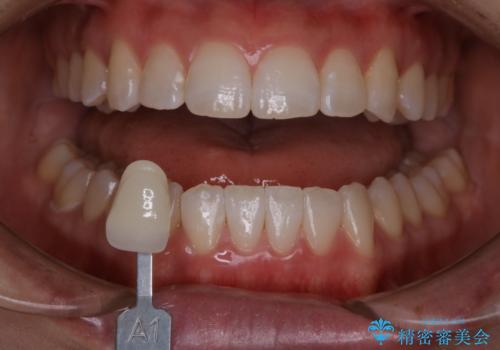 初めてのホワイトニングで自然な白さにしたいの治療後