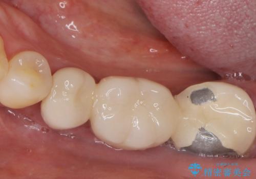 歯が痛い 深いう蝕により神経が死んでいる 50代女性の治療前