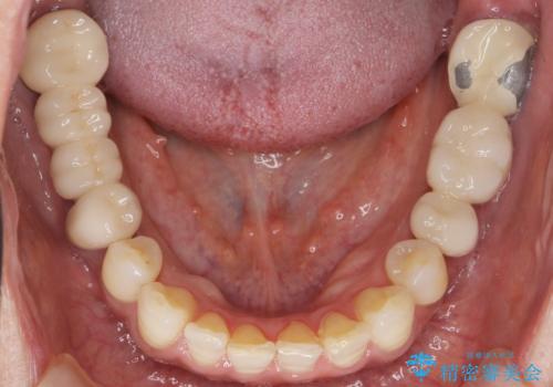 歯が痛い 深いう蝕により神経が死んでいる 50代女性の治療前