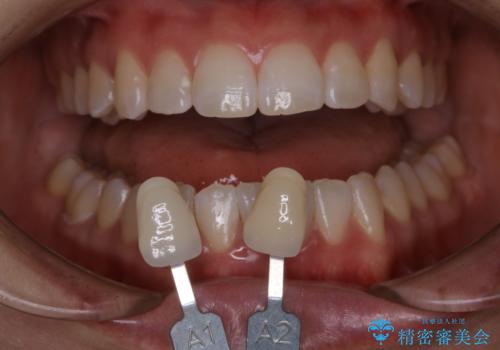 初めてのホワイトニングで自然な白さにしたい