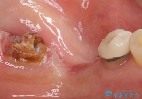 歯が痛い 深いう蝕により神経が死んでいる 50代女性の治療中