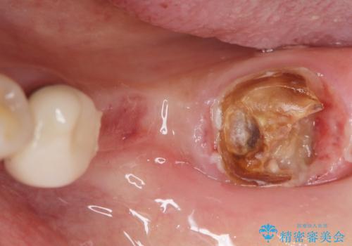 歯が痛い 深いう蝕により神経が死んでいる 50代女性