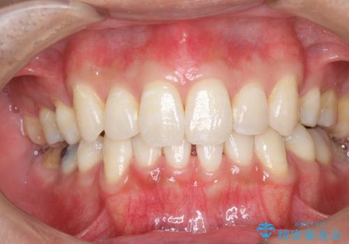 オフィスホワイトニングで、天然の歯を今より白く明るく!!