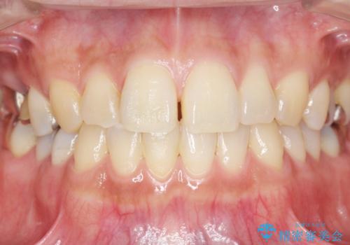 低価格でしっかりとしたインプラント治療 30代男性の治療後