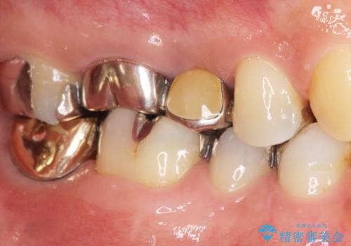 低価格でしっかりとしたインプラント治療 30代男性の治療後