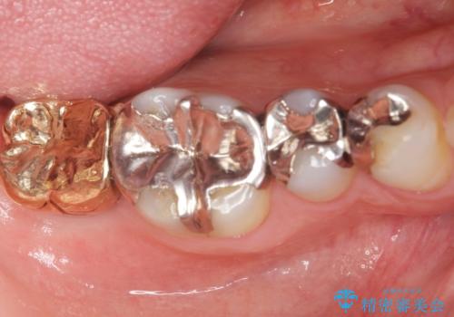 低価格でしっかりとしたインプラント治療 30代男性の治療後