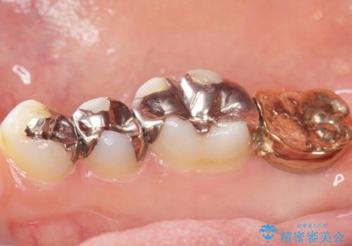 低価格でしっかりとしたインプラント治療 30代男性の治療後