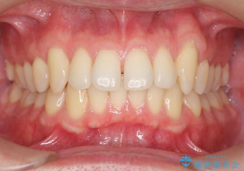 前歯のすき間 セラミックで綺麗に 最短で治療の治療前