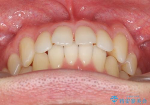 前歯のすき間 セラミックで綺麗に 最短で治療の治療前