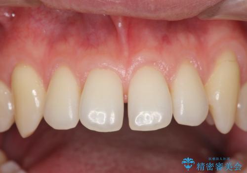 前歯のすき間　セラミックで綺麗に　最短で治療の治療前