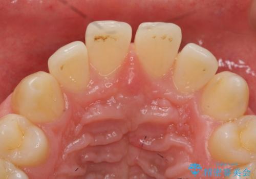 前歯のすき間 セラミックで綺麗に 最短で治療の治療前