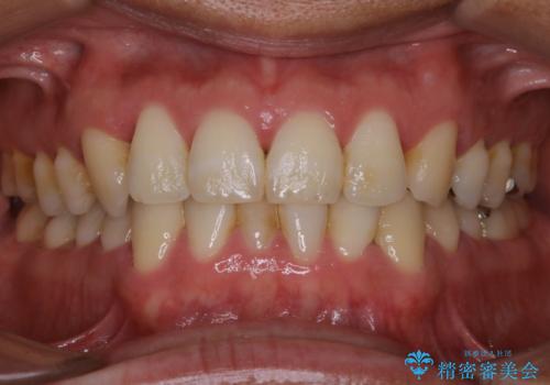 数年ぶりの歯医者で歯を白くしたいの症例 治療前