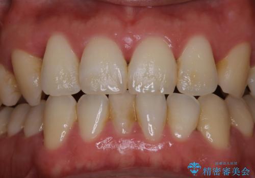 数年ぶりの歯医者で歯を白くしたいの治療前