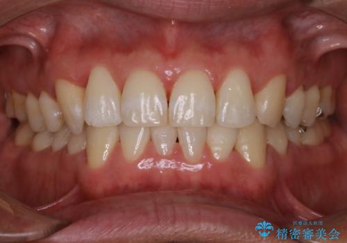 数年ぶりの歯医者で歯を白くしたいの症例 治療後