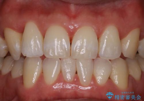 数年ぶりの歯医者で歯を白くしたいの治療後