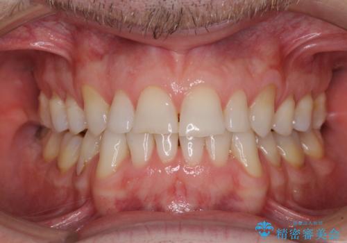 抜歯矯正の後戻りが気になる インビザライン・ライトによる矯正治療の治療中