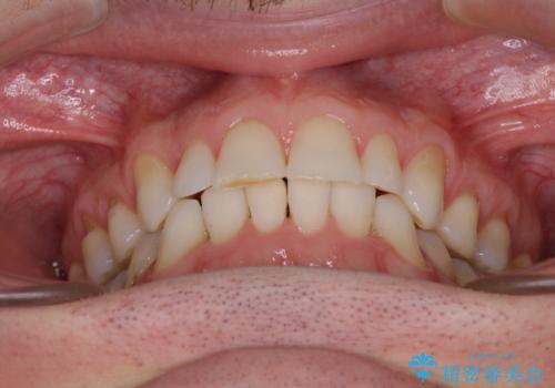 抜歯矯正の後戻りが気になる インビザライン・ライトによる矯正治療の治療中