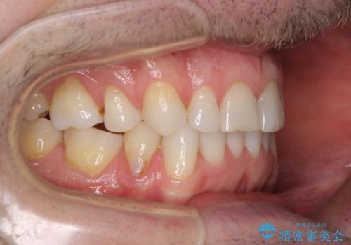 抜歯矯正の後戻りが気になる インビザライン・ライトによる矯正治療の治療中
