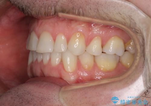 抜歯矯正の後戻りが気になる インビザライン・ライトによる矯正治療の治療中