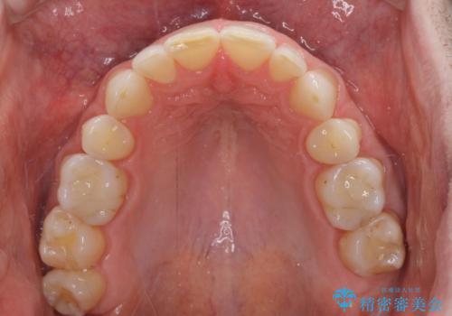抜歯矯正の後戻りが気になる インビザライン・ライトによる矯正治療の治療中