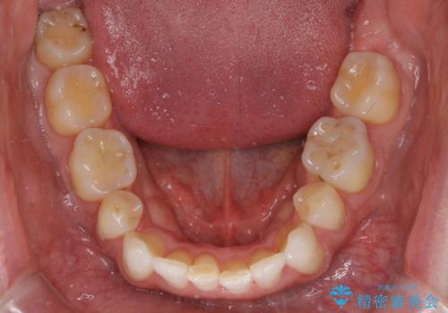 抜歯矯正の後戻りが気になる インビザライン・ライトによる矯正治療の治療中