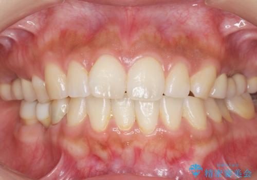 インプラントも入れ歯も嫌 親知らずの移植 20代女性の治療後