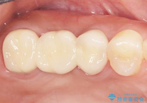 インプラントも入れ歯も嫌 親知らずの移植 20代女性の治療後