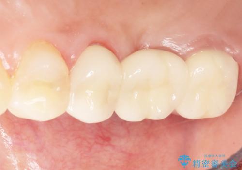 インプラントも入れ歯も嫌 親知らずの移植 20代女性の治療後