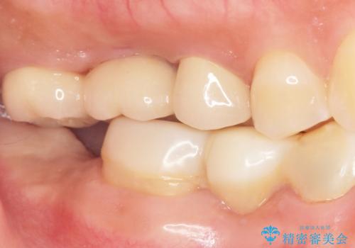 インプラントも入れ歯も嫌 親知らずの移植 20代女性の治療後