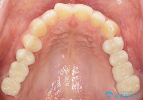 インプラントも入れ歯も嫌 親知らずの移植 20代女性の治療後