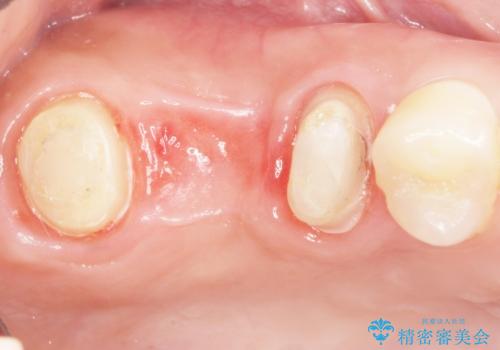 インプラントも入れ歯も嫌 親知らずの移植 20代女性の治療前