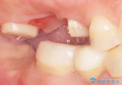 インプラントも入れ歯も嫌 親知らずの移植 20代女性の治療後