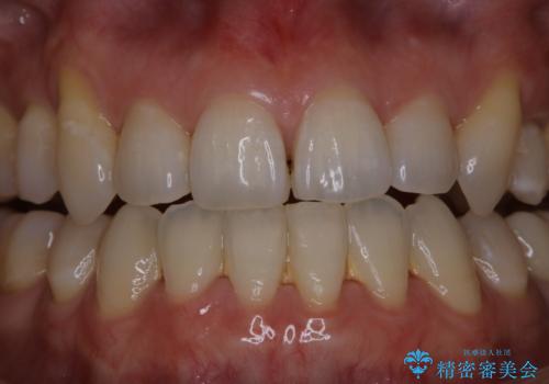 数年ぶりに歯科医院で歯石除去の治療前