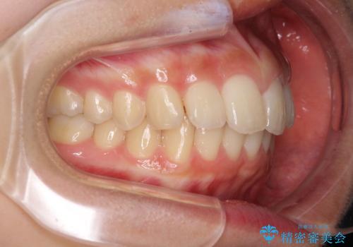 就職前にきれいな歯並びにしたい 大学生のインビザライン矯正の治療中