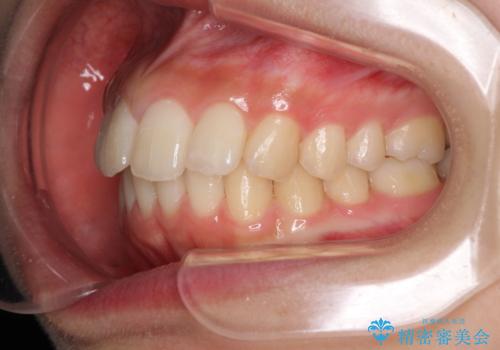 就職前にきれいな歯並びにしたい 大学生のインビザライン矯正の治療中