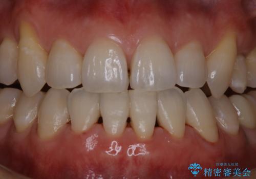 数年ぶりに歯科医院で歯石除去の治療後