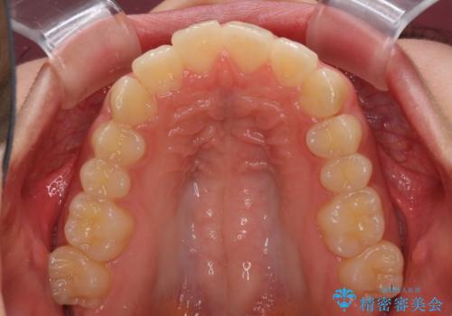 就職前にきれいな歯並びにしたい 大学生のインビザライン矯正の治療中