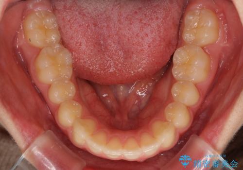 就職前にきれいな歯並びにしたい 大学生のインビザライン矯正の治療中