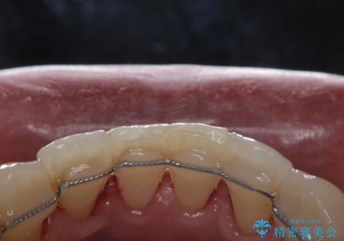 数年ぶりに歯科医院で歯石除去の治療後